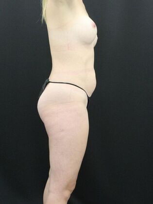 Tummy Tuck: Case 16 - Before