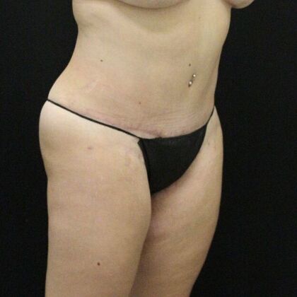 Tummy Tuck: Case 20 - After