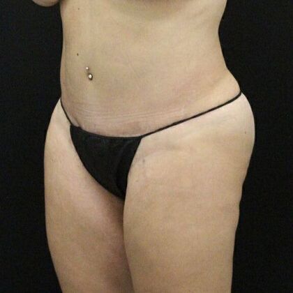 Tummy Tuck: Case 20 - After