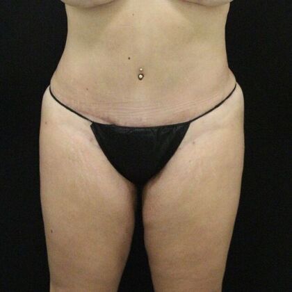Tummy Tuck Case 20 - After