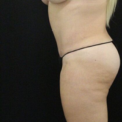 Tummy Tuck: Case 20 - After