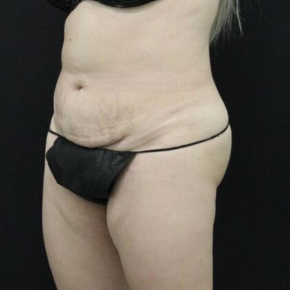 Tummy Tuck: Case 20 - Before