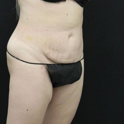 Tummy Tuck: Case 20 - Before