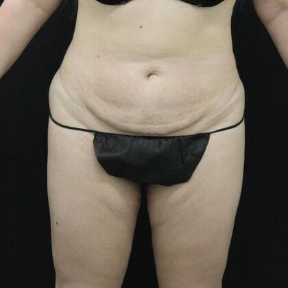 Tummy Tuck Case 20 - Before