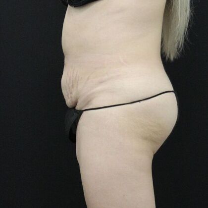 Tummy Tuck: Case 20 - Before