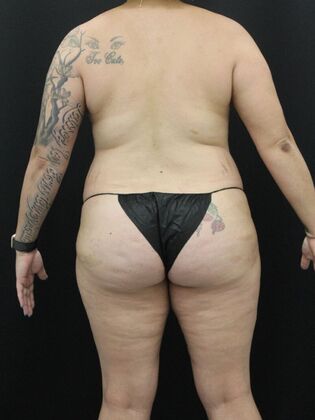 Tummy Tuck: Case 22 - Before