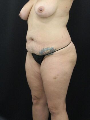 Tummy Tuck: Case 22 - Before