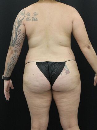 Liposuction Case 24 - Before