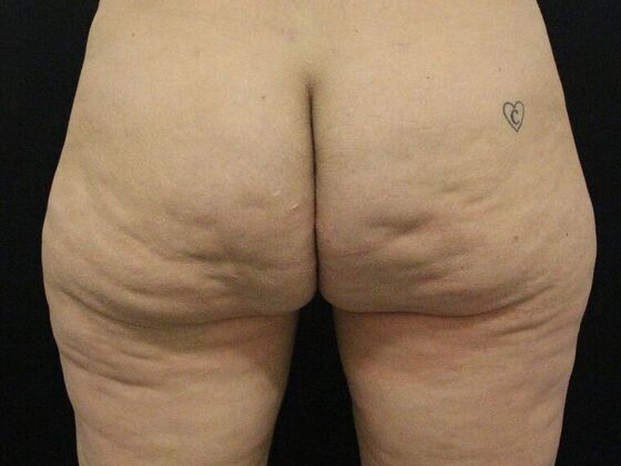 Aveli Cellulite Treatment Case 1 - Before