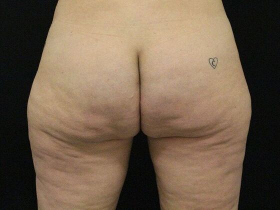 Aveli Cellulite Treatment Case 1 - After
