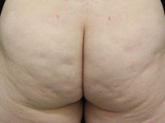 Aveli Cellulite Treatment Case 2 - Before
