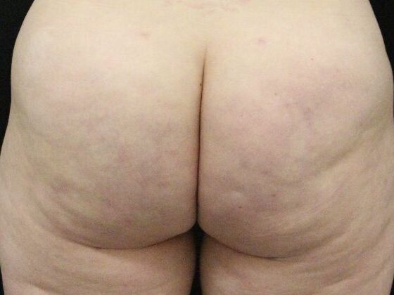 Aveli Cellulite Treatment Case 2 - After