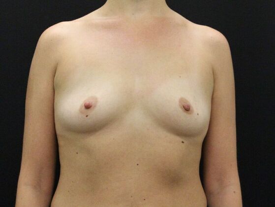 Breast Augmentation Case 17 - Before
