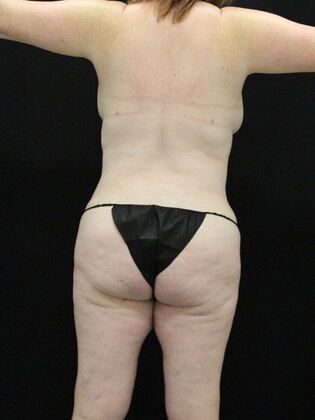 Liposuction Case 25 - After