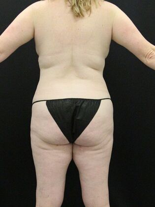 Liposuction Case 25 - Before