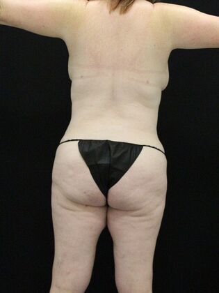 Tummy Tuck: Case 29 - After