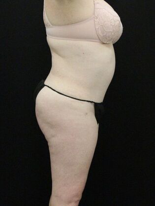 Tummy Tuck: Case 29 - After