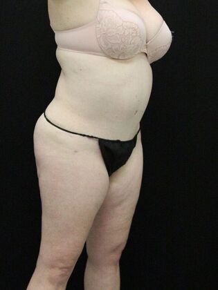 Tummy Tuck: Case 29 - After