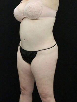 Tummy Tuck: Case 29 - After