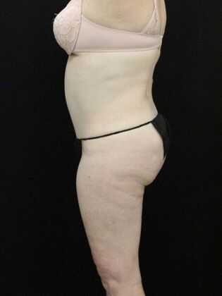 Tummy Tuck Case 29 - After