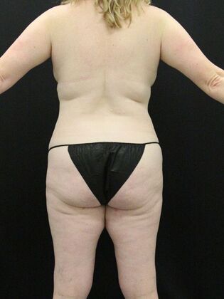 Tummy Tuck: Case 29 - Before