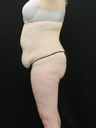 Tummy Tuck Case 29 - Before