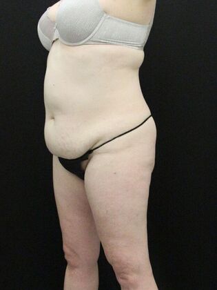 Tummy Tuck: Case 29 - Before