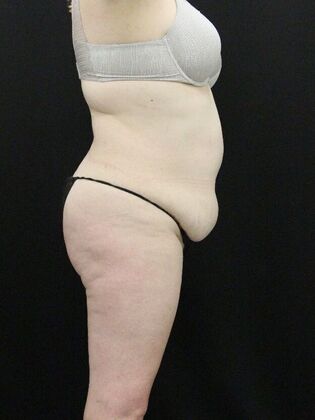 Tummy Tuck: Case 29 - Before