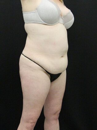 Tummy Tuck: Case 29 - Before