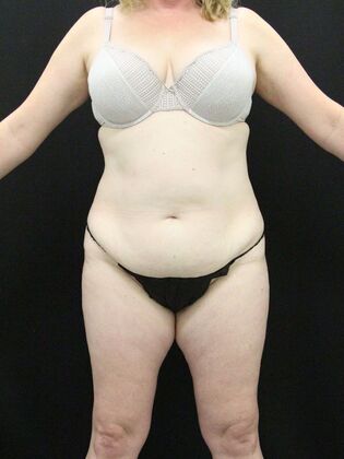 Tummy Tuck: Case 29 - Before
