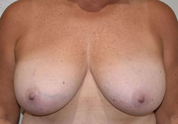 Breast Reduction: Case 164 - Before