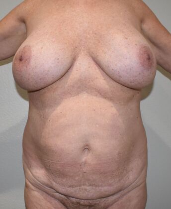 Mommy Makeover Case 280 - Before