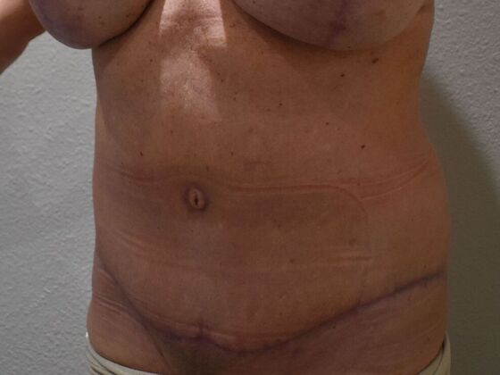 Tummy Tuck (Abdominoplasty): Case 432 - After