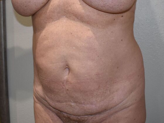 Tummy Tuck (Abdominoplasty): Case 432 - Before
