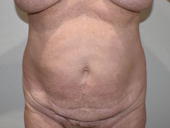 Tummy Tuck (Abdominoplasty): Case 432 - Before