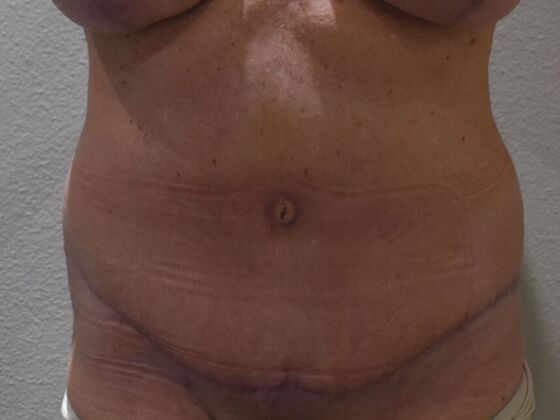 Tummy Tuck (Abdominoplasty): Case 432 - After