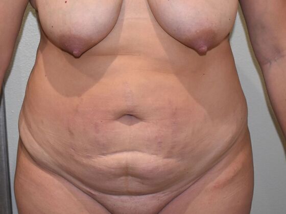 Tummy Tuck (Abdominoplasty) Case 145 - Before