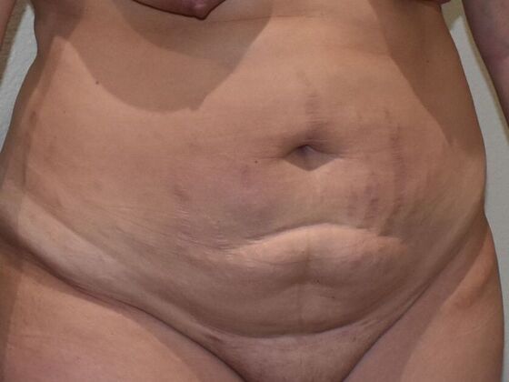 Tummy Tuck (Abdominoplasty): Case 145 - Before