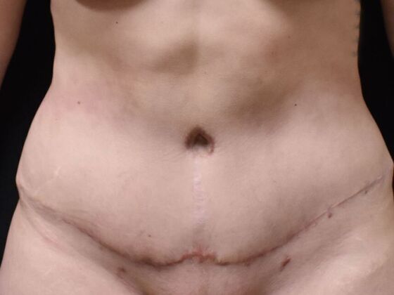 Tummy Tuck (Abdominoplasty) Case 145 - After