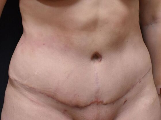 Tummy Tuck (Abdominoplasty): Case 145 - After