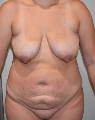 Mommy Makeover Case 281 - Before