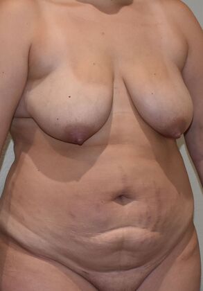 Mommy Makeover: Case 281 - Before