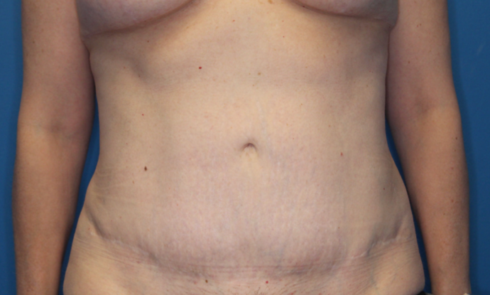 Abdominoplasty Case 2 - After