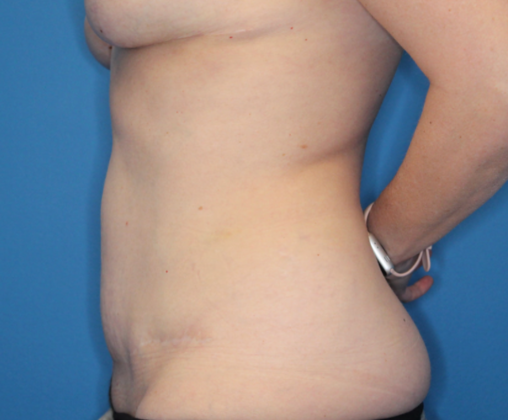 Abdominoplasty: Case 2 - After