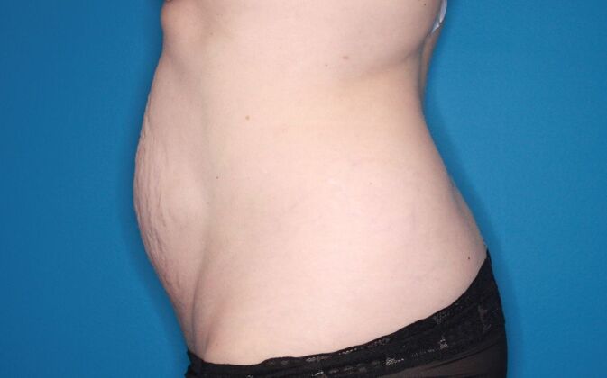 Abdominoplasty: Case 2 - Before