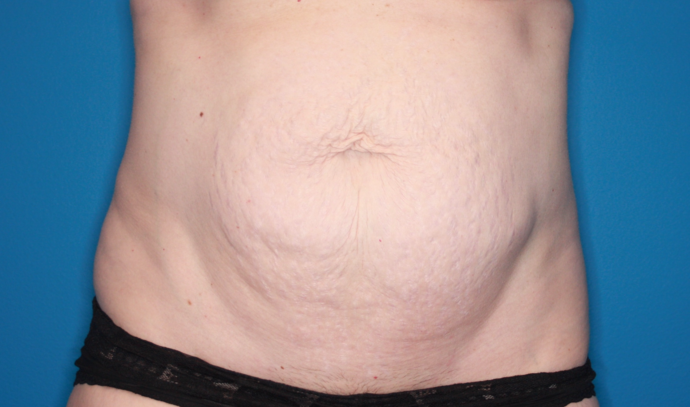 Abdominoplasty Case 2 - Before