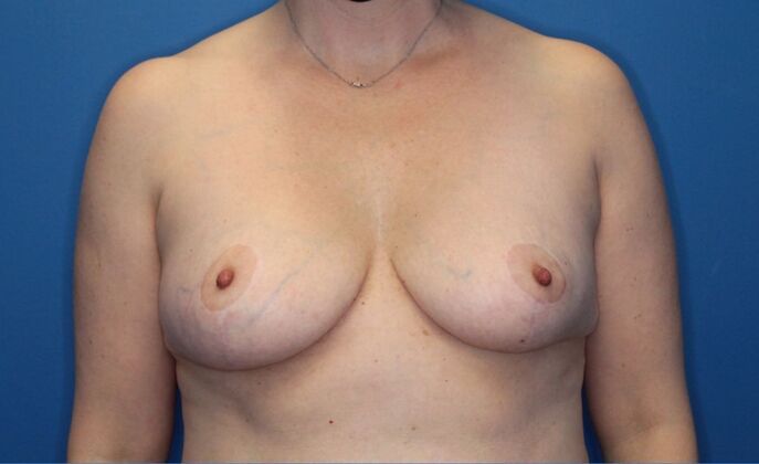 Breast Lift Case 2 - After