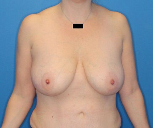 Breast Lift Case 2 - Before