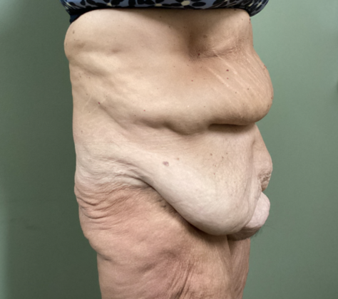 Body Contouring: Case 1 - Before