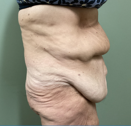 Body Contouring: Case 1 - Before
